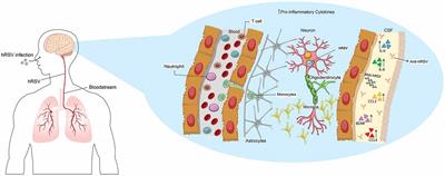 Neurologic Alterations Due to Respiratory Virus Infections